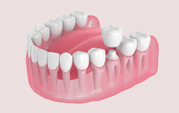 5 Ways A Dental Crown Improves Your Overall Oral Health