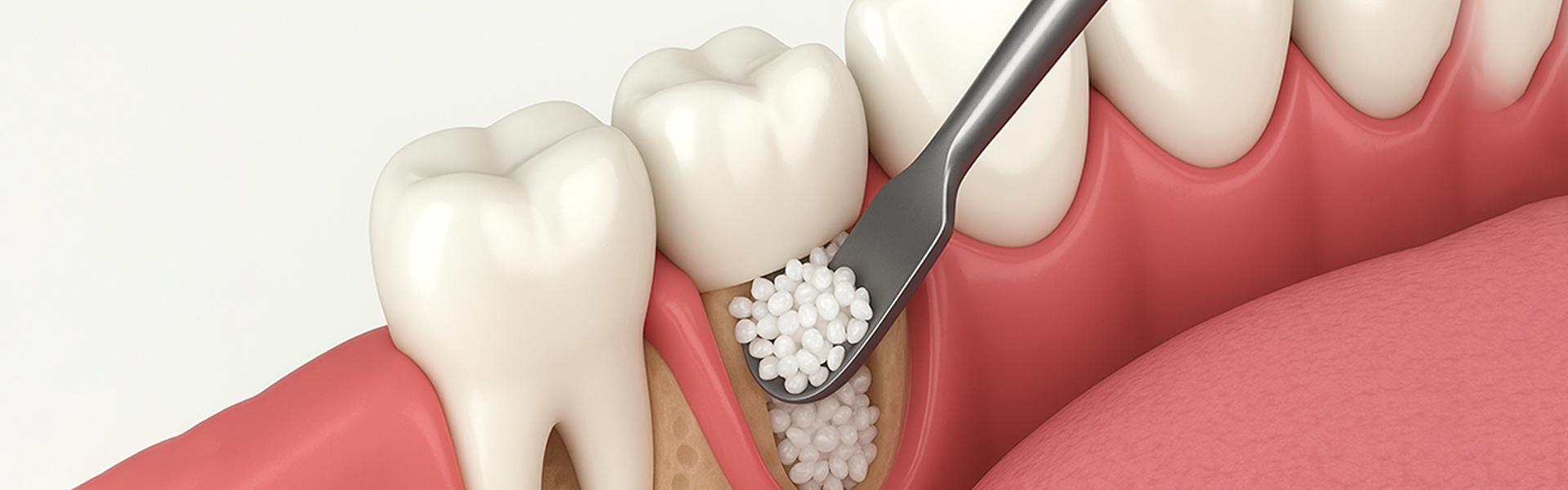 How Do I Know If I Need a Bone Graft Before Implants in Houston?