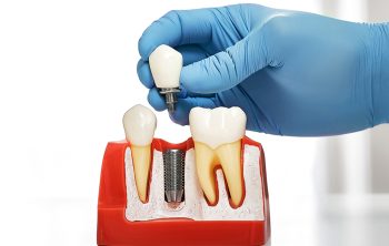 Dental Implants in Houston, TX: Everything You Need to Know Before You Book