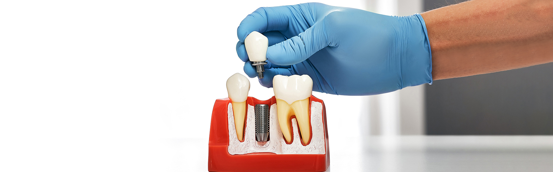 Dental Implants in Houston, TX: Everything You Need to Know Before You Book